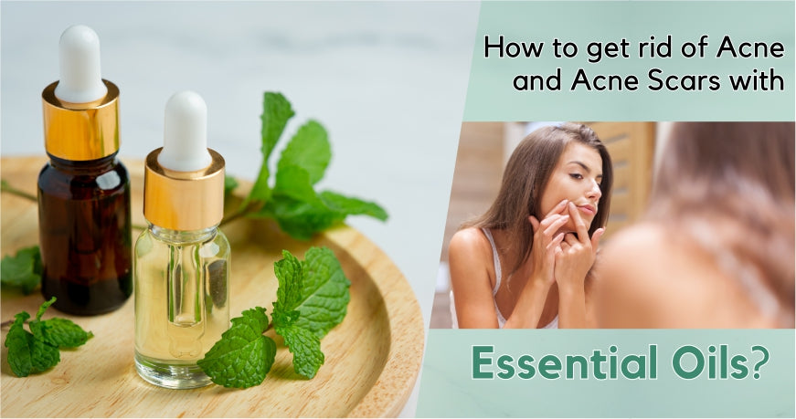 best oil for acne-prone skin and scars best oil for acne-prone skin and scars